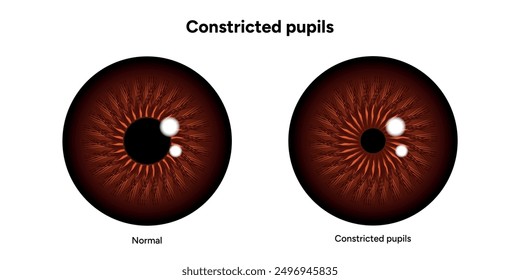 Constricted pupils eye diseases ophthalmology