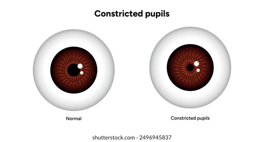 Constricted pupils eye diseases ophthalmology