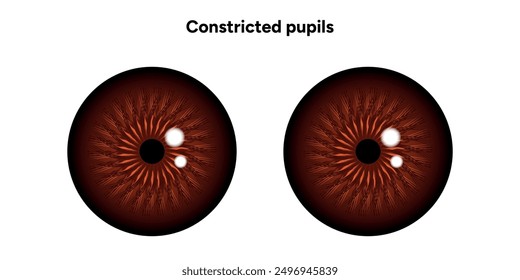 Constricted pupils eye diseases ophthalmology