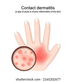 Contact dermatitis. Atopic eczema. Close-up of rash on hand. human skin with dermatitis. penetration of allergens. Vector illustration for medical, biological, and educational use