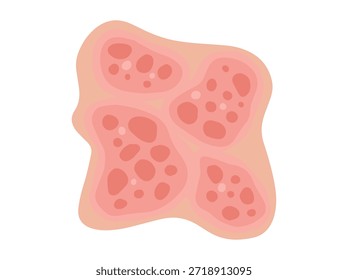 Contact Dermatitis Disease in Skin