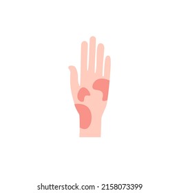 Contact dermatitis flat design long shadow color icon. Skin redness, rash, irritation. Phytophotodermatitis, poisonous plant allergy. Food, insect bite allergic symptom. Vector silhouette illustration