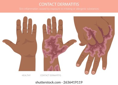 Contact dermatitis. Skin diseases. Medical infographic design. Vector illustration