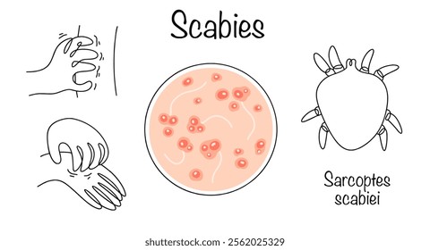 A contagious skin disease caused by the scabies mite Sarcoptes scabiei. A drawn manifestation of scabies on the skin and the causative agent of the disease. Medical vector on white background.