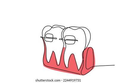 Continuous line art of Orthodontic treatment. Dentists day and respect for their services to humanity. Dental procedures vector art concept. Isolated vector of teeth and jaws. Retainers braces denture