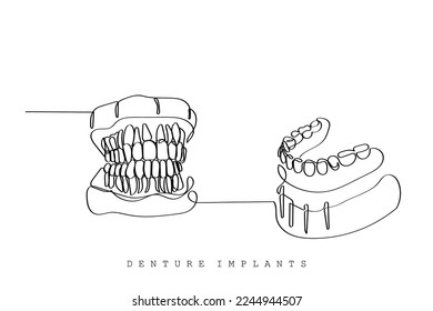 Continuous line art of orthodontic treatment. Denture Implants and procedure. Vector art design.