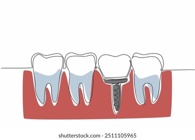 Continuous one line drawing teeth are aligned and one of them is an implant tooth. Do everything to prevent cavities. More caring. World Oral Health Day. Single line draw design vector illustration