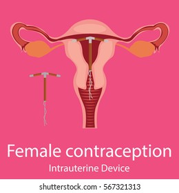 Contraception Intrauterine spiral.