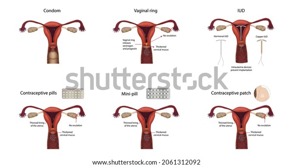 Contraception\
methods. IUD, contraceptive patch, pills, mini-pill, condom,\
vaginal ring. Vector medical\
illustration.
