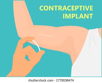 Contraceptive implant premenstrual syndrome family planning infertility counseling stop ovulation fertilization