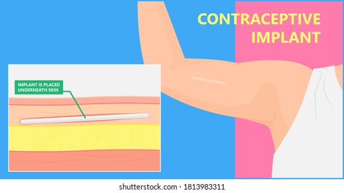 Contraceptive Implant Premenstrual Syndrome Family Planning Infertility Counseling Stop Ovulation Fertilization