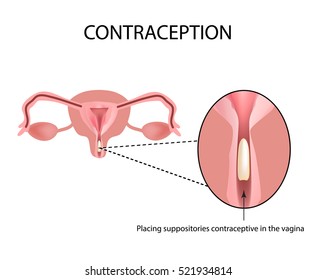Contraceptives suppositories. Infographics. Vector illustration on isolated background.