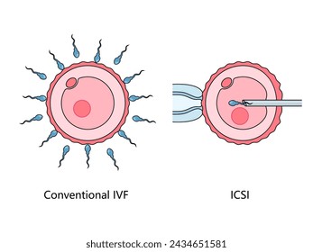 contrasting conventional In Vitro Fertilization (IVF) with Intracytoplasmic Sperm Injection (ICSI) technique hand drawn schematic vector illustration. Medical science educational illustration