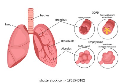 COPD (chronic obstructive pulmonary disease). Emphysema of the lungs. Lung disease. Infographics. Vector illustration in cartoon style isolated on white background.