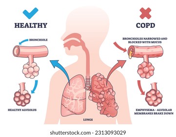 COPD oder chronisch obstruktive Lungenerkrankungen Erläuterungsdiagramm. Bezeichnete pädagogische Medizin mit gesunden und Atemwegserkrankungen Lungen Vergleich Vektorgrafik. Körperdiagnose