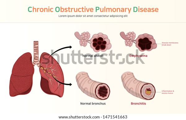 COPD (Chronic\
Obstructive Pulmonary\
Disease)