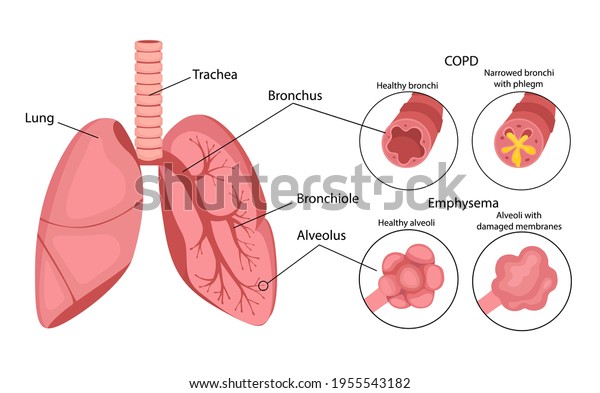 COPD (chronic obstructive\
pulmonary disease). Emphysema of the lungs. Lung disease.\
Infographics. Vector illustration in cartoon style isolated on\
white background.