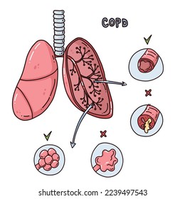 COPD illustration. Chronic obstructive pulmonary disease. Emphysema of the lungs. lung disease. Vector illustration in cartoon style.