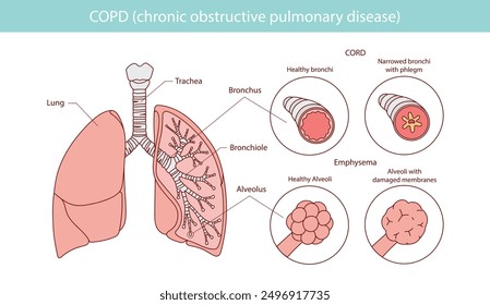 COPD infographic: manifests itself in two forms emphysema and bronchitis