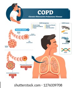 COPD vector illustration. Labeled chronic obstructive pulmonary disease explanation. Lungs inflammation symptoms and causes diagram. Compared healthy airways and emphysema or bronchitis type sickness.