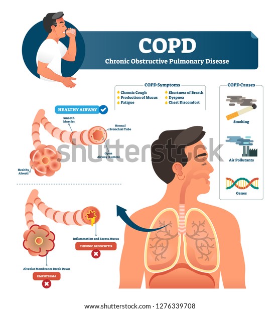 COPD vector illustration. Labeled chronic\
obstructive pulmonary disease explanation. Lungs inflammation\
symptoms and causes diagram. Compared healthy airways and emphysema\
or bronchitis type\
sickness.