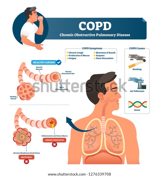 Copdのベクターイラスト 慢性閉塞性肺疾患の説明書 肺の炎症 の症状と図を引き起こす 健康な気道と気腫 気管支炎の病気と比較しました のベクター画像素材 ロイヤリティフリー