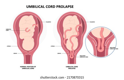 cord fatal labor delivery of the fetus baby birth twins fluid breech c section Overt Funic Occult vasa previa obstetrical water breaking transverse lie