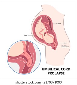 cord fatal labor delivery of the fetus baby birth twins fluid breech c section Overt Funic Occult vasa previa obstetrical water breaking transverse lie