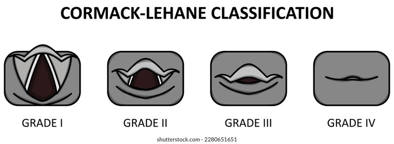 The Cormack-Lehane system classifies views obtained by direct laryngoscopy based on the structures seen.