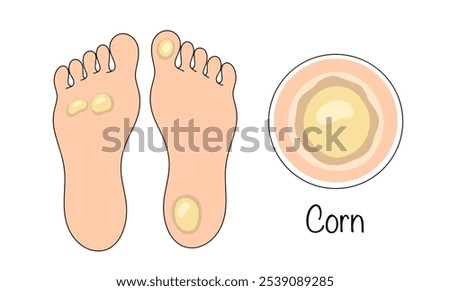 Corn. Small areas of thickened skin that appear as a result of increased pressure on a specific area of the foot. Color illustration for different uses. 
