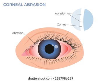 Corneal abrasion illustration. Eye redness symptom. pink red surfer's eye