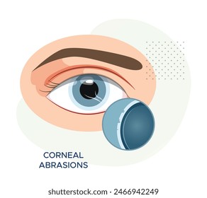 Corneal Abrasions - superficial scratch on Cornea - Stock Illustration as EPS 10 File