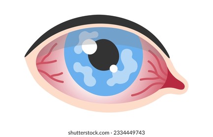 Corneal Herpes Epithelial Type Eye Disease Vector Illustration