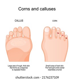 Corns on toe and calluses on sole. comparison and differences human's feet with corns and callus. Large area and Small lumps of ​​rough, thick skin that forms as a response to repeated friction