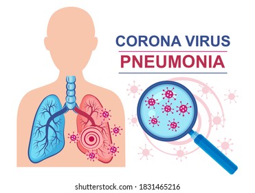 Corona virus pneumonia disease sign. Lungs infection. Normal and affected lung against of male silhouette. Coronavirus under magnifying glass. Treatment inflammation human respiratory system. Vector 