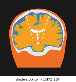 Coronal view Illustration of deep brain stimulation at subthalamic nucleus for the treatment of parkinson's disease. Vector illustration. 