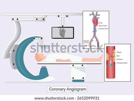 A coronary angiogram CAG is a test that uses X-rays and contrast dye to show how well blood is moving in coronary (heart) arteries by Fluoroscopy Machine (C-arm or Biplane Cath Lab)