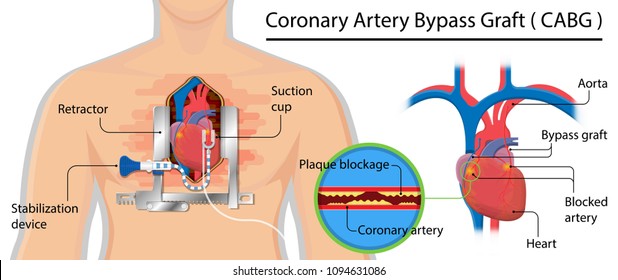Coronary artery bypass grafting CABG open heart surgery surgical blocked fatty material forms transplant operation attack beating CAD treat CPB
