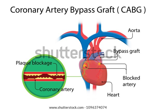 coronary-artery-bypass-grafting-cabg-open-heart-surgery-surgical