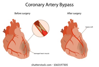 Coronary Artery Bypass, Medical Flat Vector Illustration. Damaged Heart Muscle, Blocked Artery, Bypass Craft.