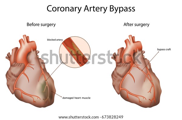 Coronary artery bypass,\
medical vector illustration. Damaged heart muscle, blocked artery,\
The bypass graft restores normal blood flow to an obstructed\
coronary artery.