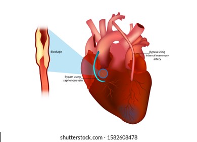 Coronary artery bypass surgery (Bypass using internal mammary artery and Bypass using saphenous vein)