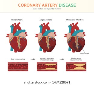 Angina 图片 库存照片和矢量图 Shutterstock