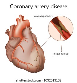 Coronary artery disease. Blocked artery, damaged heart muscle. Anatomy illustration. Colorful image, white background.