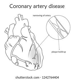 Coronary Artery Disease Images Stock Photos Vectors