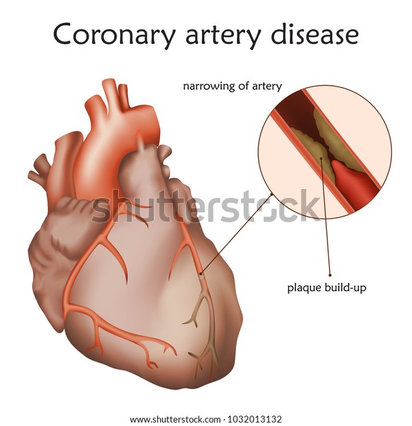 Coronary\
artery disease. Blocked artery, damaged heart muscle. Anatomy\
illustration. Colorful image, white\
background.
