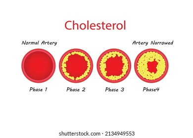 Coronary Artery Disease Is The Buildup Of Plaque In The Arteries That Supply Oxygen-rich Blood To Your Heart. Plaque Causes A Narrowing Or Blockage That Could Result In A Heart Attack. 