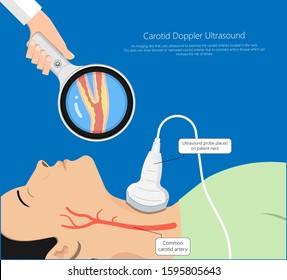 Coronary artery disease CAD diagnosis carotid duplex doppler ultrasound study treat Endarterectomy transient ischemic attack test TIA blocked blood flow neck stent
