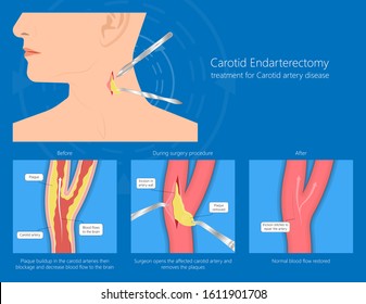 Coronary Artery Disease CAD Diagnosis Carotid Duplex Doppler Ultrasound Study Treat Endarterectomy Transient Ischemic Attack Test TIA Blocked Blood Flow Neck Stent