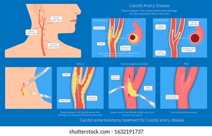 Coronary Artery Disease CAD Diagnosis Carotid Duplex Doppler Ultrasound Study Treat Endarterectomy Transient Ischemic Attack Test TIA Blocked Blood Flow Neck Stent